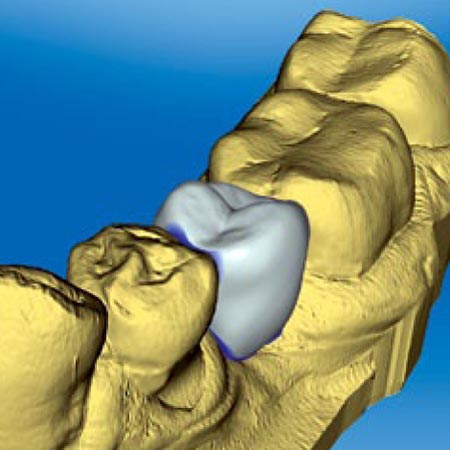 cerec digital impression and placement of a dental crown