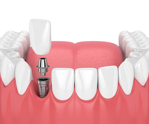 single dental implant front lower tooth