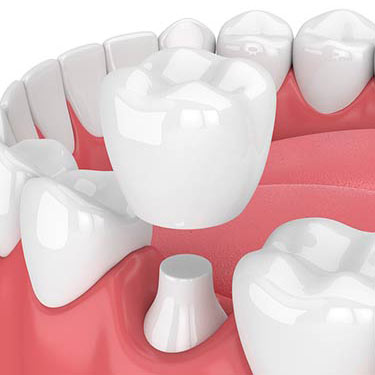 dental crown placed on lower back tooth