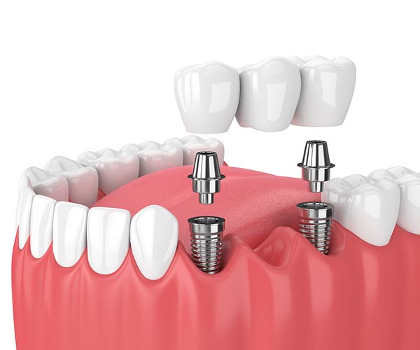 two dental implants supporting a dental bridge