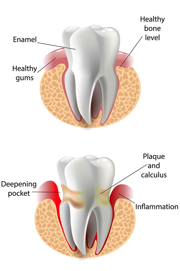 periodontal disease illustration